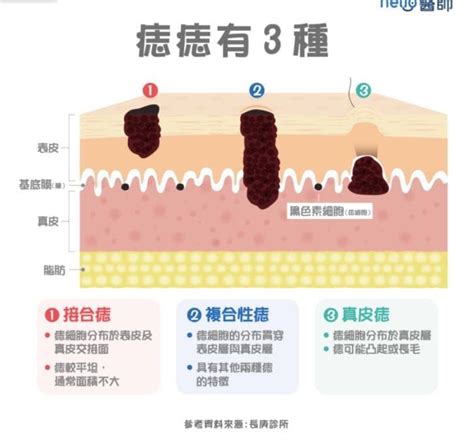 頭皮有痣